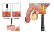 تستخدم العيادة آلة العلاج الصوتية ESWT ثنائية القناة لعلاج الضعف الجنسي لتدليك الجسم بالكامل